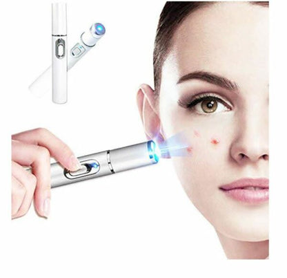 Blue Light Acne Laser Treatment