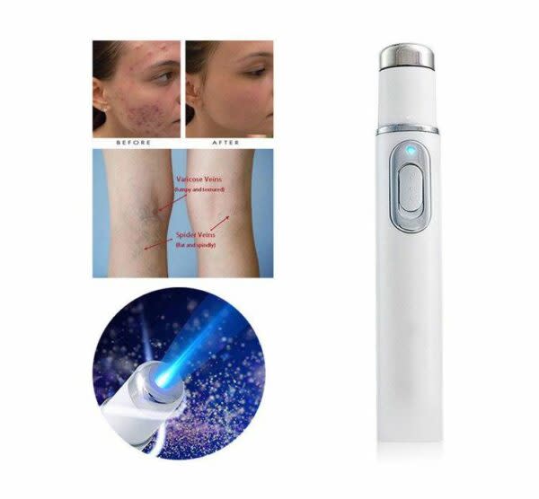 Blue Light Acne Laser Treatment