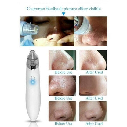 Aorlis Rechargeable Blackhead  Aspirator Facial Cleaning